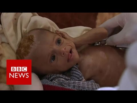 A Yemeni Child Dies Every 10 Minutes as Saudi Attacks Continue