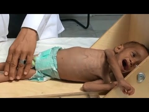 Saudi-Led War on Yemen has Killed 85,000 Children
