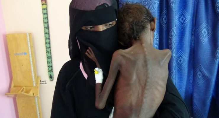 Yemen Hospital Struggles with Number of Malnourished Children